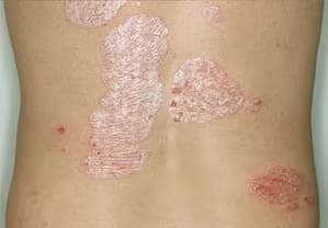 Psoriasis