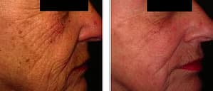 Skin Rejuvenation, Före - Efter