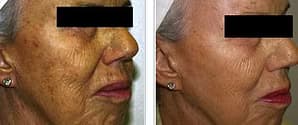 Skin Rejuvenation, Före - Efter