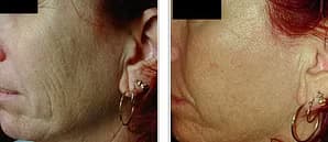 Skin Rejuvenation, Före - Efter