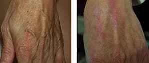 Skin Rejuvenation, Före - Efter